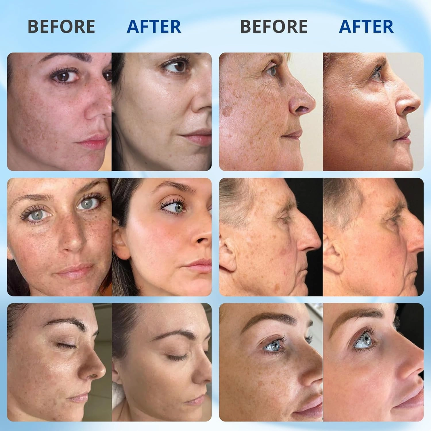 ABERA Retinol Serum, Anti-Aging Serum for Deep Wrinkles, Best Remover Melasma Treatment For Face, Niacinamide Spots Removal Serum, Dark Spot Correcting Glow Serum, Remove Freckle Skincare (Set 2)