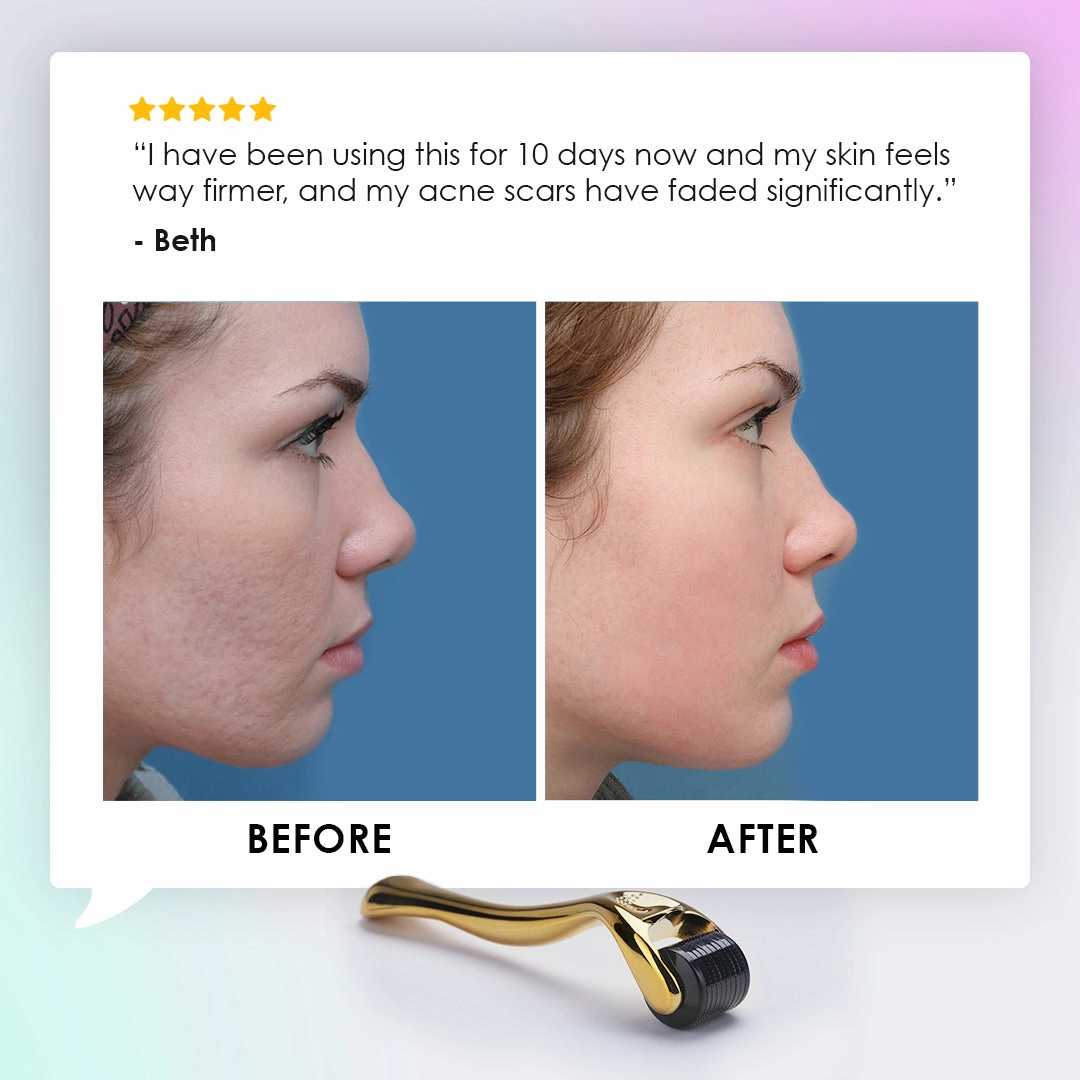 Acne Scarring Derma Roller Bundle (4 Pcs)
