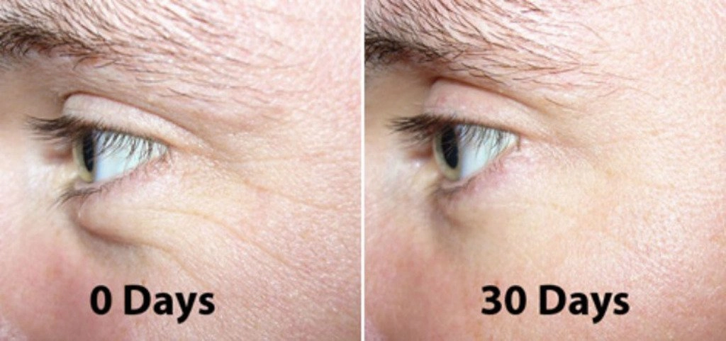 Anti Aging-No Needle Alternative- Pure Argireline Peptides Moisturizer w/Matrixyl 3000 Hyaluronic Acid