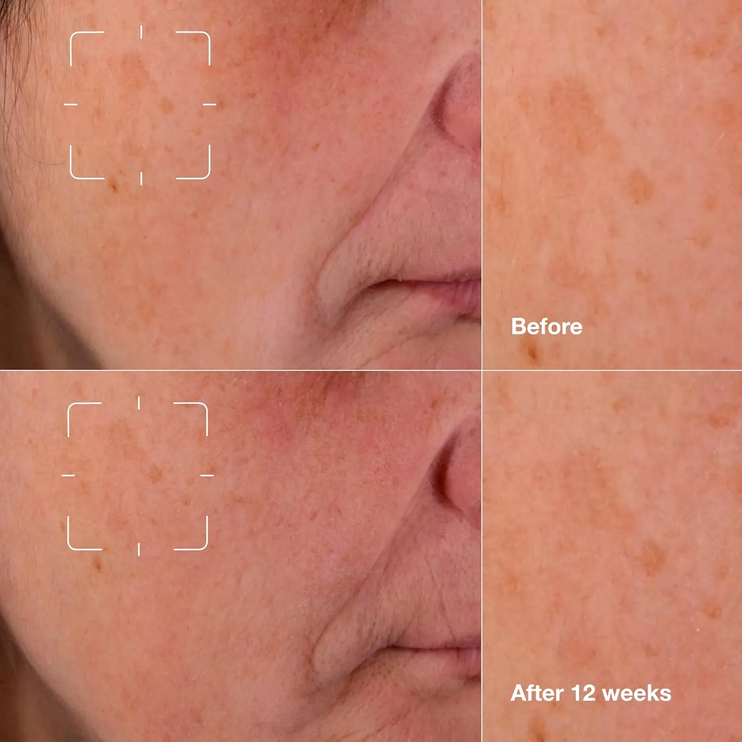 Clinique Even Better Clinical Dark Spot Clearing Serum With Vitamin C | Brightening   Soothing