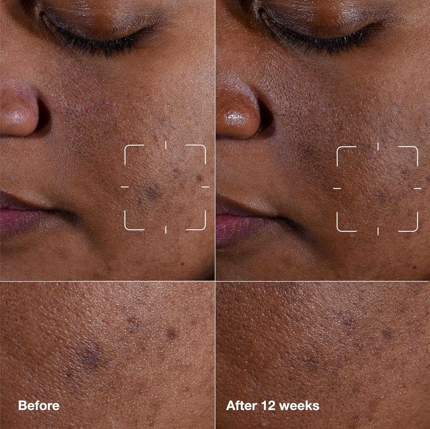 Clinique Even Better Clinical Dark Spot Clearing Serum With Vitamin C | Brightening   Soothing