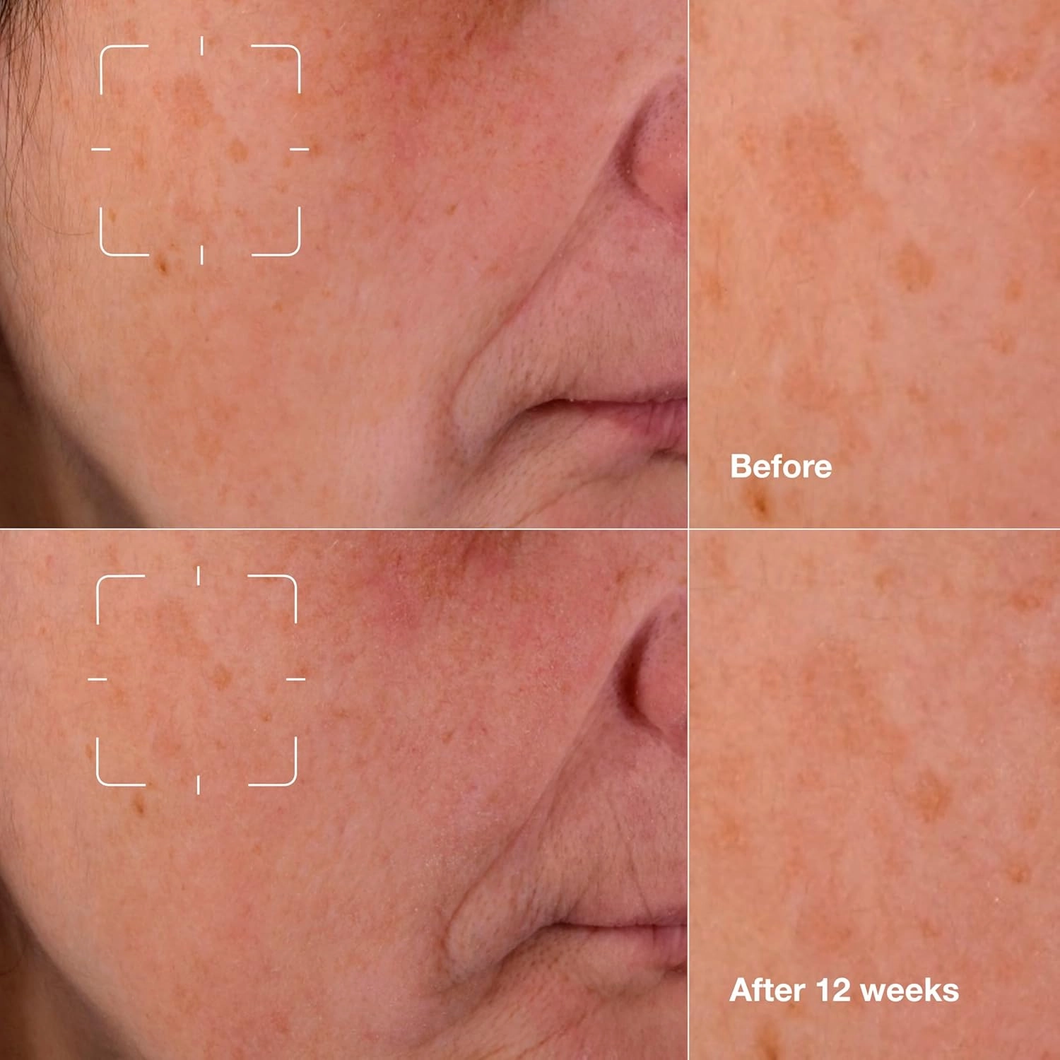 Clinique Even Better Clinical Dark Spot Clearing Serum With Vitamin C | Brightening   Soothing