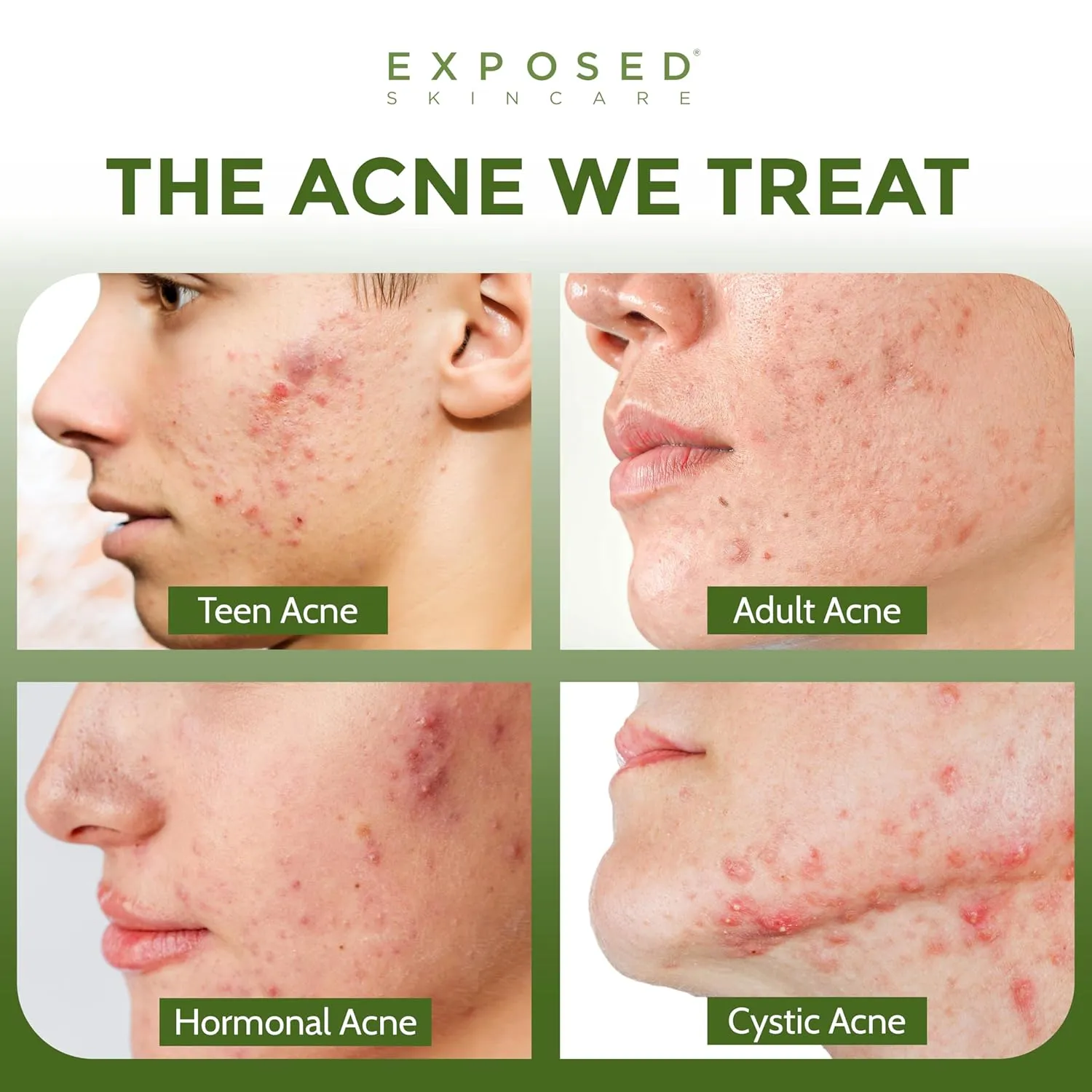 Exposed Skin Care Basic Acne Treatment Kit - Includes Salicylic Acid Face Wash, Clearing Tonic, Acne Treatment Serum with Benzoyl Peroxide, Clear Pore Serum - Acne Set Solution for All Skin Types