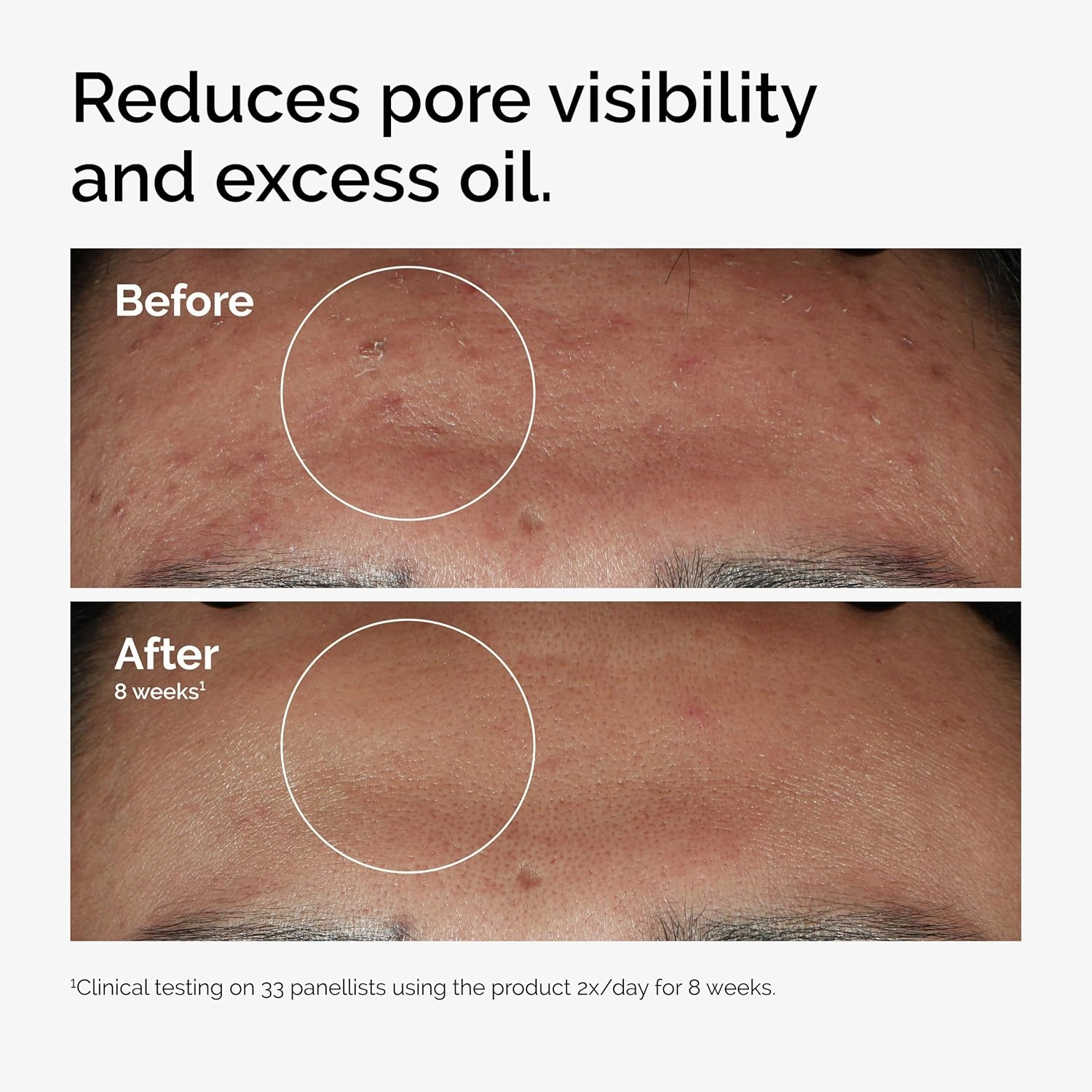 The Ordinary Niacinamide 10%   Zinc 1% Serum for Face - Pore Reducer, 30ml